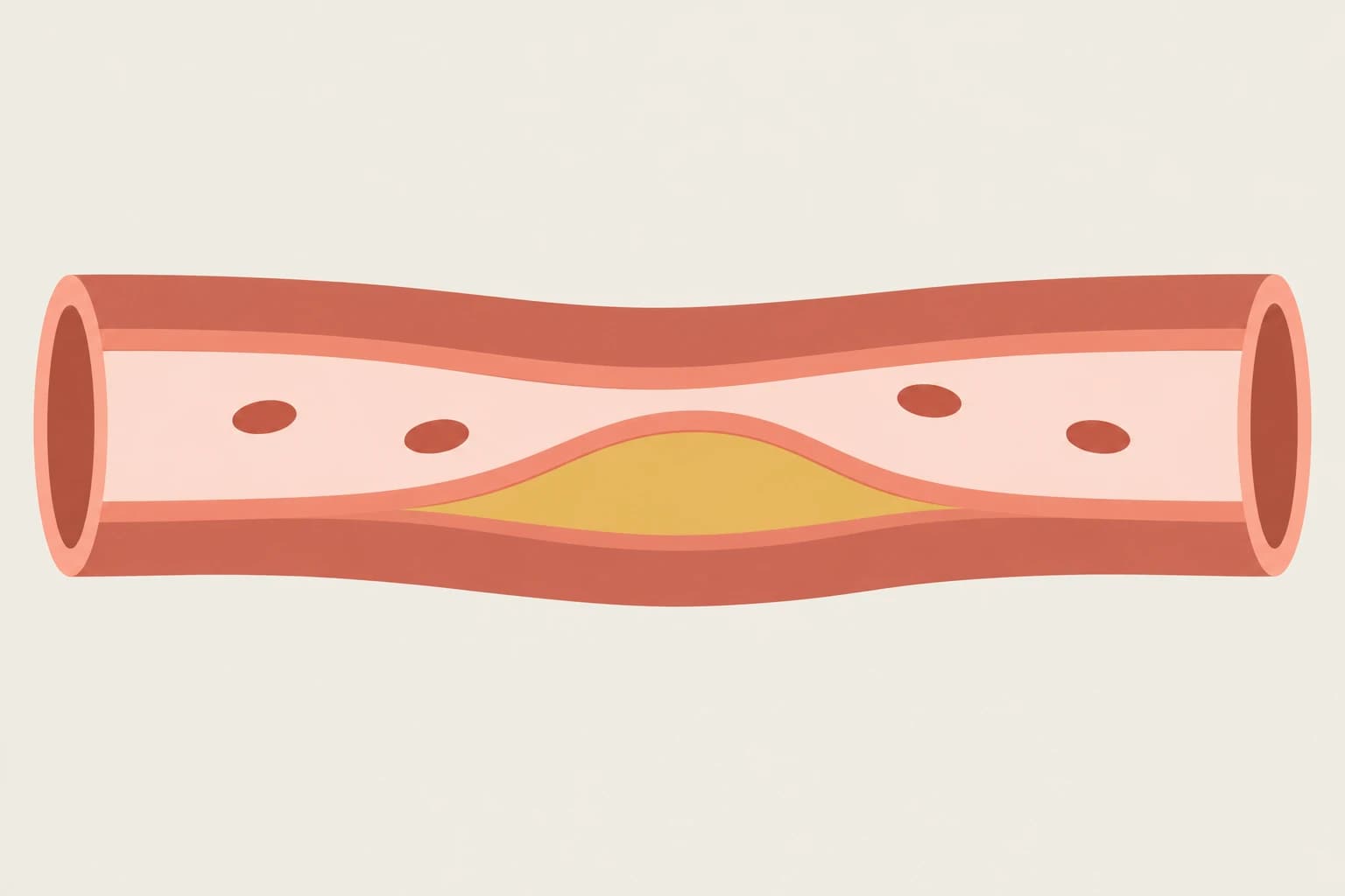 Flat cutaway illustration of an artery. Gold plaque within the lower coral wall narrows the pale central passage, which remains open for blood flow.